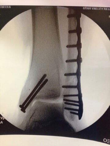 Post-op x-ray #2. Look at all of those screws!